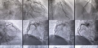 Malattie vascolari responsabili del 22% dei decessi l’anno, al via Consulta