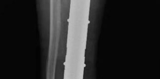 Chirurgia, la gamba bionica di Mario salvata da una protesi di caviglia su misura