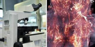 Covid invade il cervello, ecco il ‘film’. E la proteina Spike rimane per anni