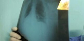 L’indagine, 63% dei post online su cancro al polmone riguarda terapie