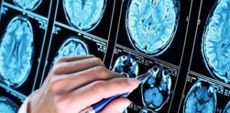 Nuova frontiera anti-Alzheimer: così si combattono le proteine tossiche