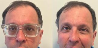 Salute, oculista Appiotti: “Lenti Icl efficaci anche in miopie moderate”