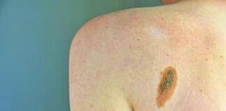 L’oncologo Ascierto: “Aumentano casi melanoma, lampade abbronzanti come fumo”