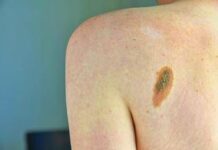 Melanoma, Ascierto (Scito): “Con immunoterapia più speranze per metà forme gravi”