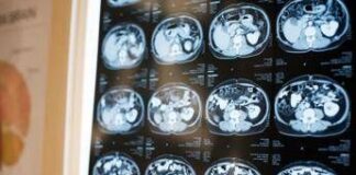 Neurologi: “Noi fondamentali in gestione neoplasie cerebrali”