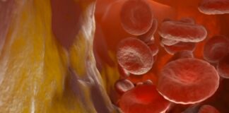 Studio italiano, terapia a Rna riduce colesterolo Ldl di oltre 60%