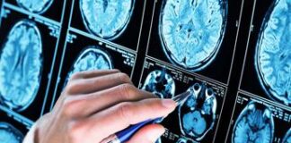 Team italiano scopre nuovo gene coinvolto in malattia Alzheimer