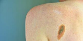 Tumori, +30% diagnosi melanoma in 2024, mai così tanti
