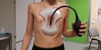 Storia di Marco il nuotatore, guarito dal petto escavato grazie al ‘sottovuoto’