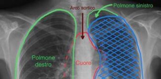 Tumore gli comprimeva cuore e polmone, salvato con complesso intervento alle Molinette
