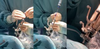 Ulss 8 Berica, nuovo braccio elettronico per la Neurochirurgia dell’Ospedale San Bortolo di Vicenza ulss 8 braccio elettronico in dotazione al San Bortolo di Vicenza