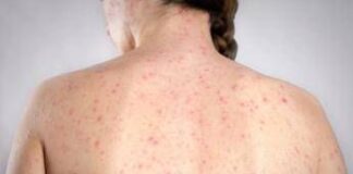 Morbillo, la verità sulla vitamina A: “Non riduce il rischio di contrarre la malattia”