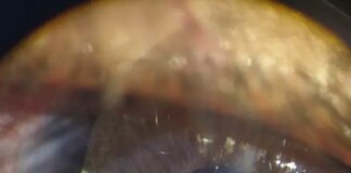 A Torino nuovi occhi per fratello e sorella nati senza iride