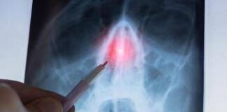 Rinosinusite cronica con poliposi nasale, l’otorino: “Con biologici verso remissione”