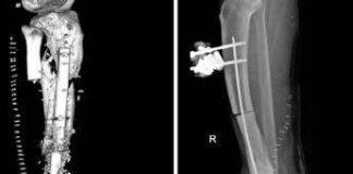 Batterio gli ‘mangia’ la carne, operazione al Gemelli gli salva gamba e piede