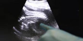 Trapianti, Uk, Amy prima bimba nata da donazione di utero da vivente