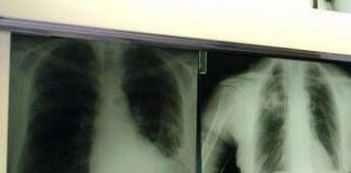 Cancro polmone a piccole cellule, ok Ue a tislelizumab