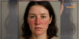 Lupus, passi in avanti nella cura di una malattia difficile da individuare