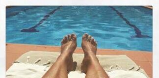 Abbronzarsi con la vitiligine, le regole del sole sicuro