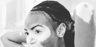 Giornata della vitiligine contro stigma e falsi miti, un ‘doppio attacco’ può batterla