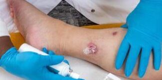 Idrosadenite suppurativa, quando fare la doccia o dormire diventano ostacoli