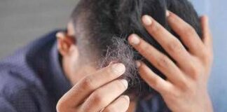Il dermatologo: “Con alopecia areata disagi e costi alti, svecchiare linee guida”
