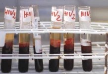 Aids, l’accusa di Bassetti: “Torna a far paura per colpa di Trump” aids