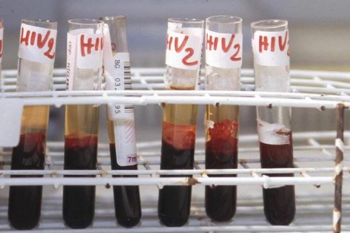 provette_analisi_hiv_aids aids