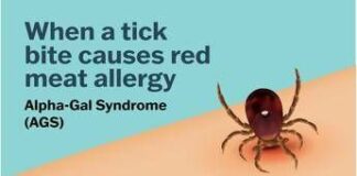 Se una zecca rende allergici a carne e latticini, cos’è la sindrome alfa-gal