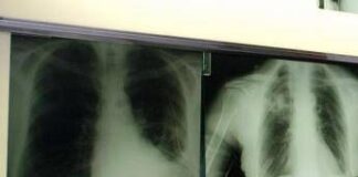 Giornata mondiale del tumore al polmone, PharmaMar: “Dal mare nuove armi per vincerlo”