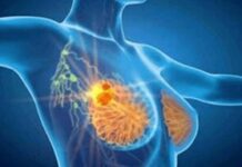 Cancro seno, con profilazione molecolare e terapie target migliori prospettive di cura