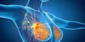 Cancro seno iniziale Her2+, con anticorpo farmaco-coniugato -53% recidiva