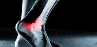 Ossa fragili dei calciatori, ecco perché post ritiro tanti soffrono di osteoartrite