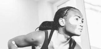 E’ la Vitiligine week, “così la terapia della luce aiuta il farmaco”