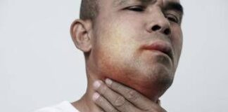 Angioedema ereditario, ok Ue a prima terapia preventiva mirata all’Rna