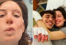 Crans-Montana, oggi dimessi due ragazzi. Eleonora Palmieri mostra le ustioni sui social