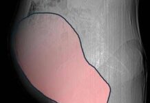 Intervento record al Sant’Anna di Torino, rimosso tumore ovarico di 6 kg