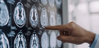 Neurologi: “Per tumori cerebrali la svolta della medicina di precisione”