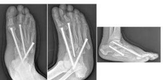 Piede di Charcot, al Gemelli soluzioni avanzate per una complicanza rara del diabete