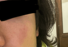 Vicenza, agenti della Polizia Locale aggrediti: Rucco (FdI) e DICCAP-SULPM chiedono più sicurezza e… taser Polizia locale di Vicenza, la ferita di uno dei due agenti aggrediti