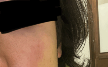 Vicenza, agenti della Polizia Locale aggrediti: Rucco (FdI) e DICCAP-SULPM chiedono più sicurezza e… taser Polizia locale di Vicenza, la ferita di uno dei due agenti aggrediti