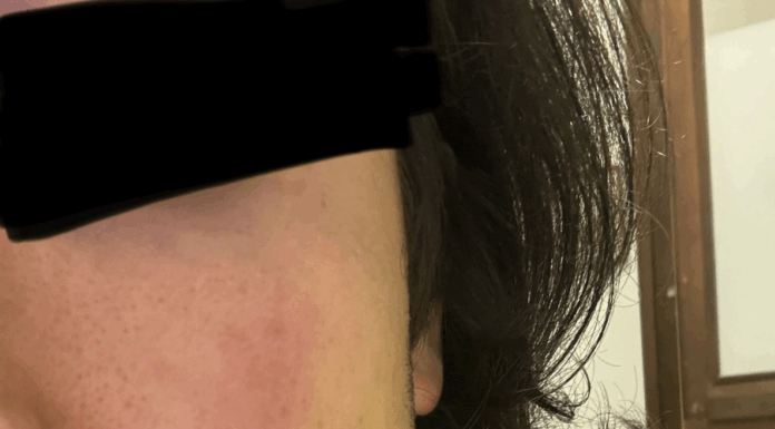 Vicenza, agenti della Polizia Locale aggrediti: Rucco (FdI) e DICCAP-SULPM chiedono più sicurezza e… taser Polizia locale di Vicenza, la ferita di uno dei due agenti aggrediti