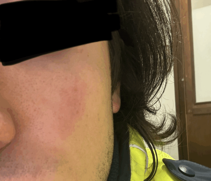 Polizia locale di Vicenza, la ferita di uno dei due agenti aggrediti