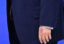 Trump e il nuovo livido sulla mano, tutte le ipotesi secondo Bassetti
