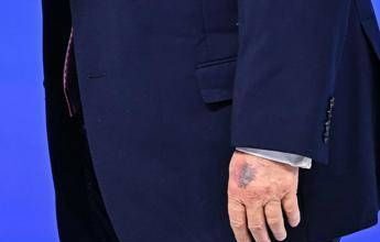 Trump e il nuovo livido sulla mano, tutte le ipotesi secondo Bassetti
