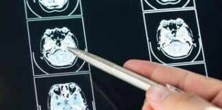 Ecco come il Long Covid cambia il cervello con meccanismi tipici dell’Alzheimer