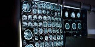 Giornata mondiale delle malattie rare, Sin rafforza impegno per patologie neurologiche