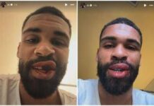 Loftus-Cheek, intervento riuscito alla mascella. E mostra foto dopo scontro in Milan-Parma