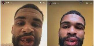 Loftus-Cheek, intervento riuscito alla mascella. E mostra foto dopo scontro in Milan-Parma