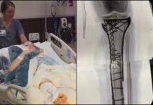 Milano Cortina, Vonn mostra la gamba dopo le operazioni: “Dolore difficile da gestire”